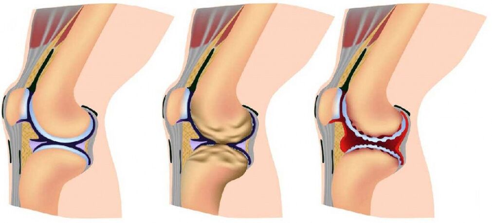 Articolazione sana e osteoartrosi colpite