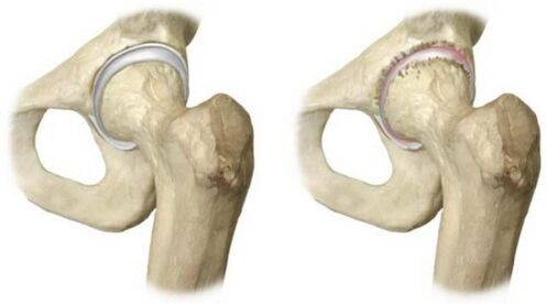 articolazione dell'anca sana affetta da osteoartrosi